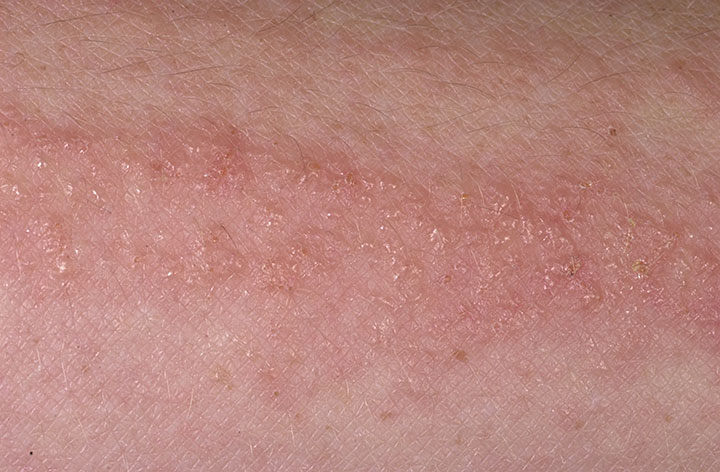 Poison Ivy Dermatitis - American Osteopathic College of ...