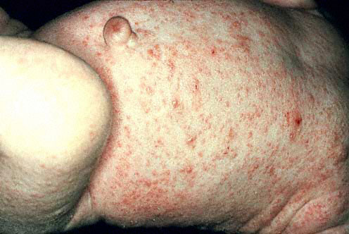 CDC - Scabies - General Information - Frequently Asked ...