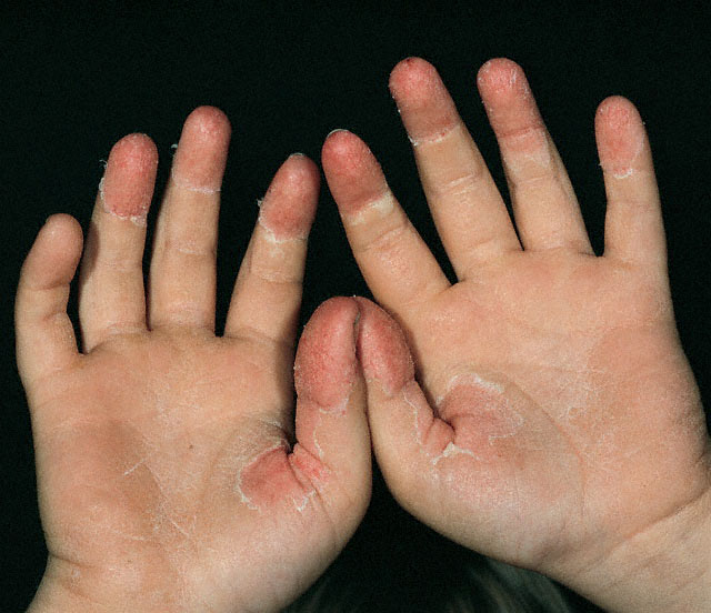 Causes of Peeling Skin on Fingers - Yogawiz