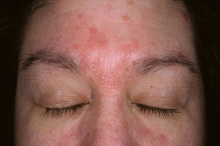 Seborrheic Dermatitis - Face - Forehead