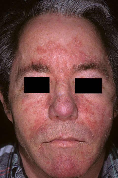 Seborrheic Dermatitis - Face