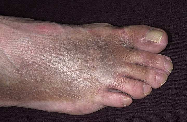 Dermatitis - Wikipedia