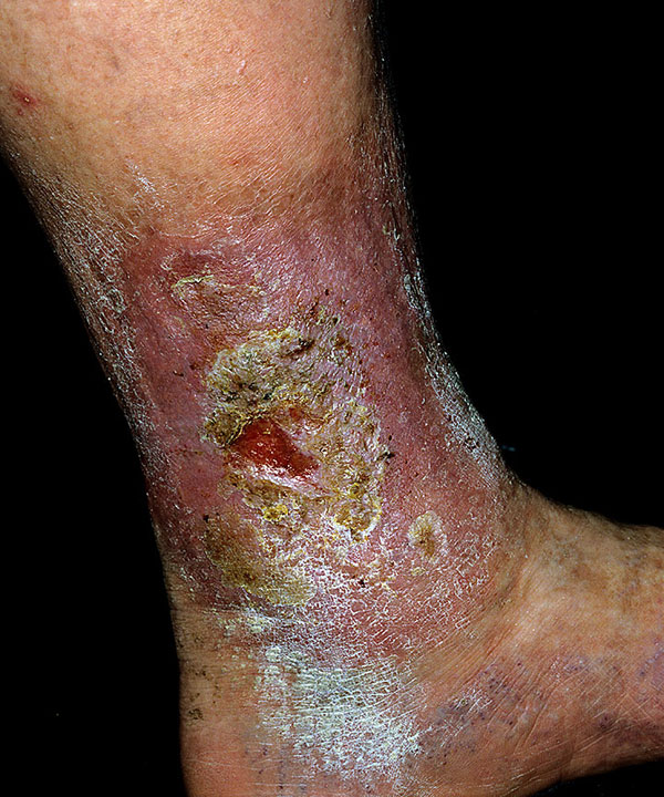 Stasis dermatitis and ulcers: MedlinePlus Medical Encyclopedia
