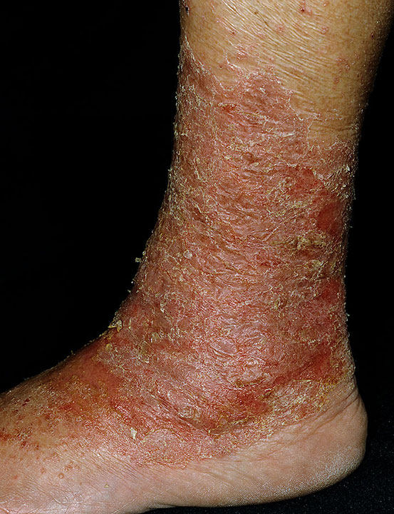 Foot Dermatitis Pictures
