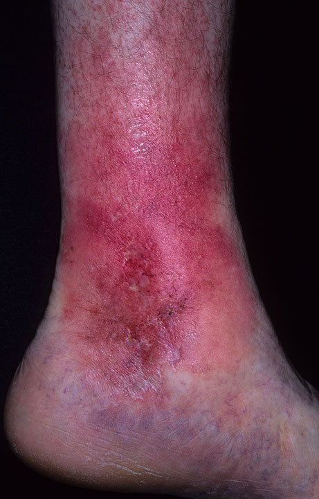 pictures of stasis dermatitis