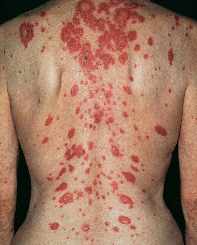 lupus rash. DermNet.com is developed & maintained by Alan N. Binnick