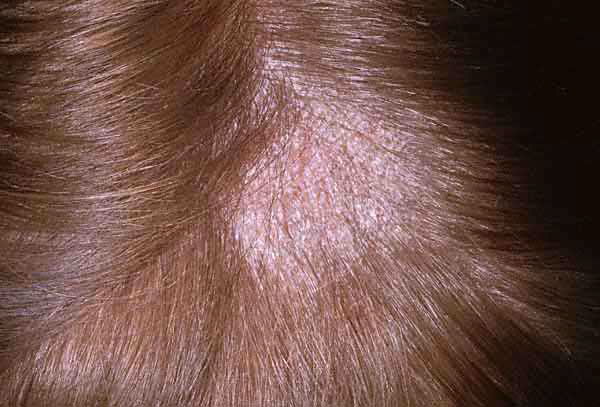 how to diagnose scalp ringworm