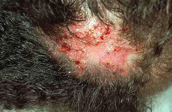 how to cure ringworm in scalp