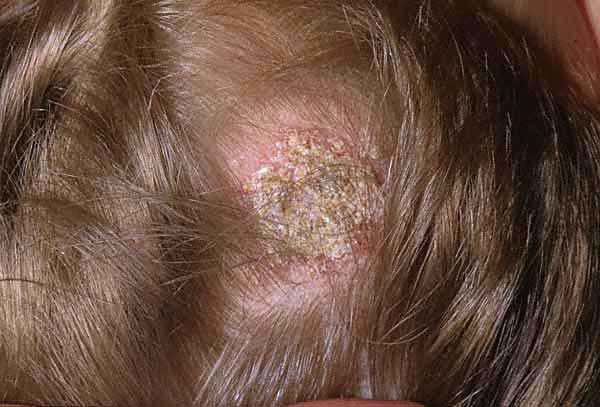 How to Treat Scalp Ringworm: 6 Steps (with Pictures ...