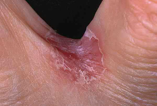 yeast infection rash