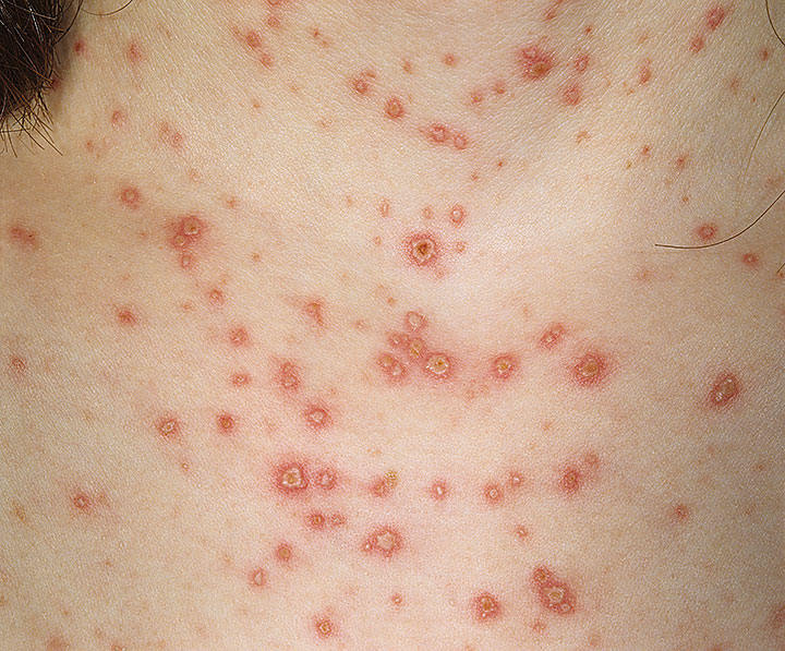 Chicken Pox Treatments Page 321