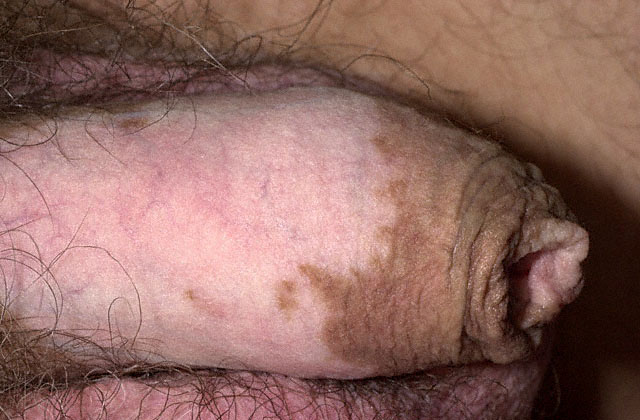Vitiligo On Penis 51