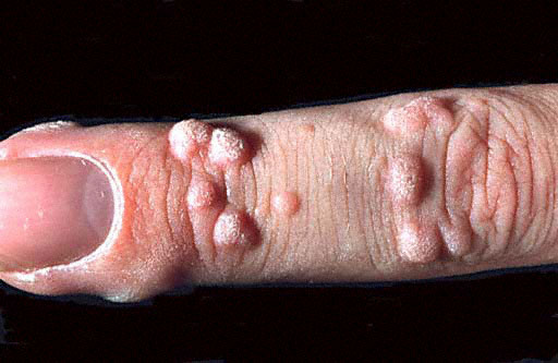 common warts on fingers. common warts on fingers.