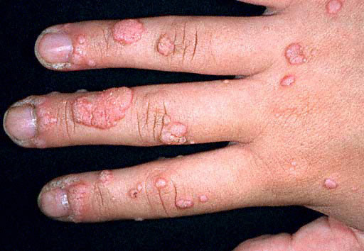 common warts on fingers. common wart on hand.