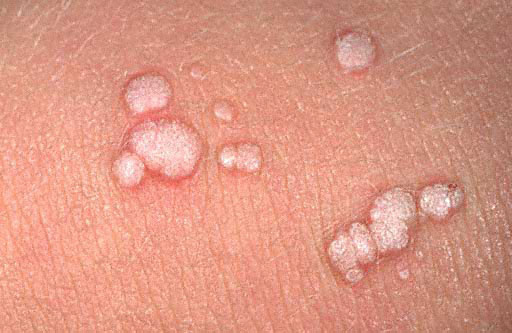 common warts on fingers. Warts+on+fingers+pictures