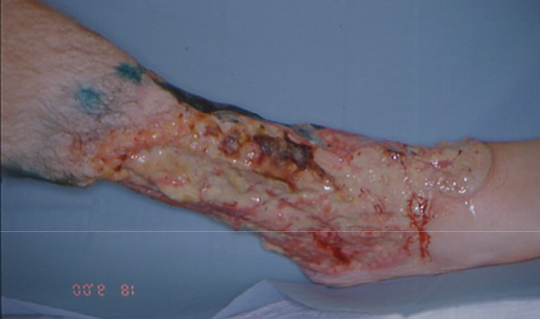 Ecthyma gangrenosum - Wikipedia