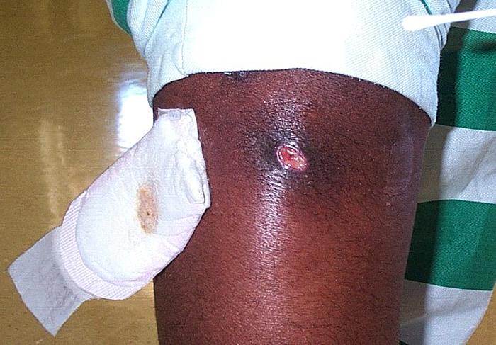 Staph Infection Rash In Children