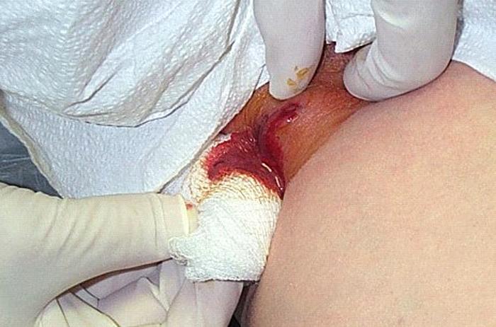 staphylococcal infections