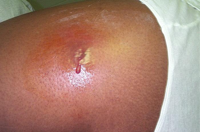 Staph Infection Rash In Children