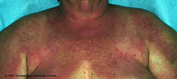 Skin Rash: 59 Pictures, Causes, Treatments - Healthline