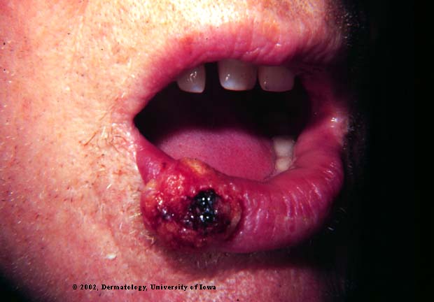 Diagnosis and Treatment of Lip Conditions for Family ...