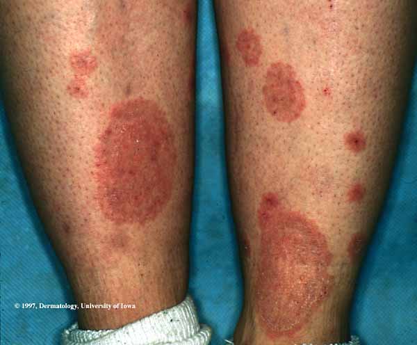 skin rash on leg pictures