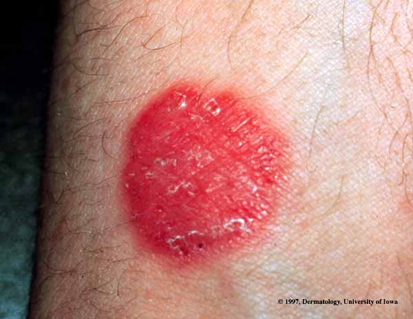 Tinea infections | Ringworm | Jock itch | MedlinePlus